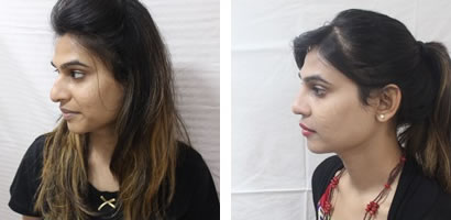 Feminizing Rhinoplasty by Dr. Kaushik