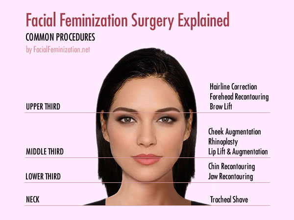 Facial Feminization Surgery Procedures Explained